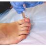YAG Laser
