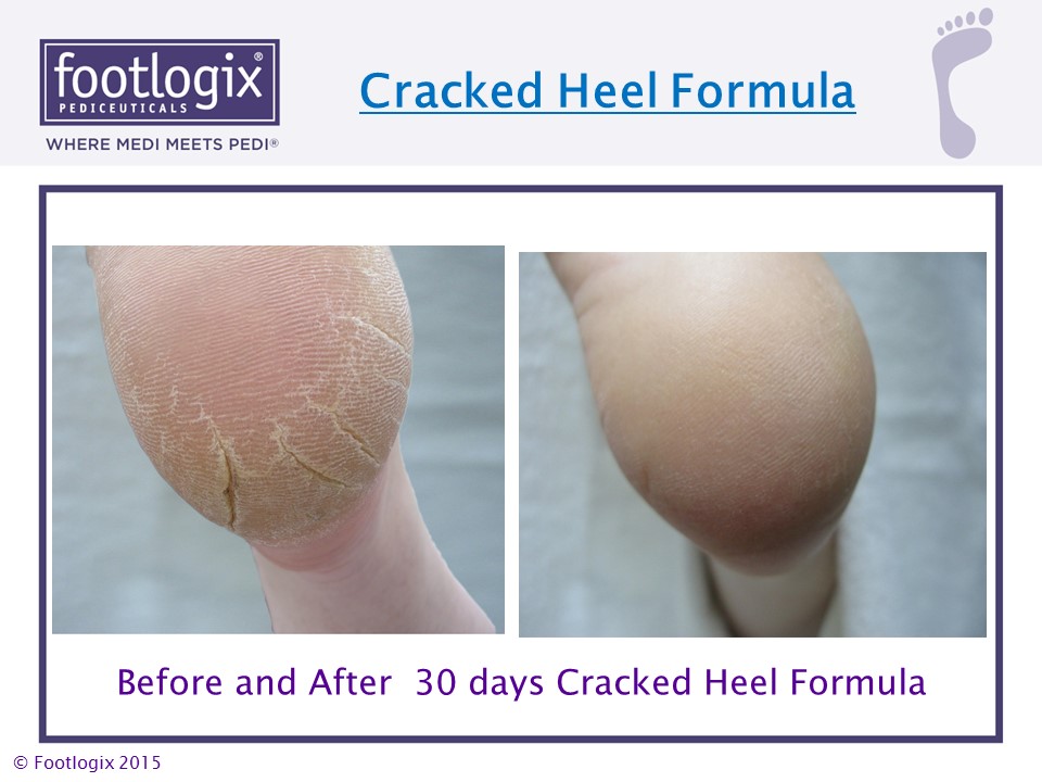 cracked heel footlogix